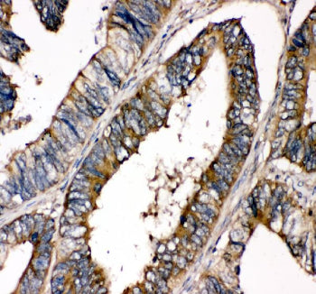 Immunohistochemical staining of FFPE human colon cancer tissue with SHP-2 antibody, HRP-secondary an
