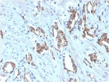 IHC staining of FFPE human prostate carcinoma with biotinylated TIGIT antibody. HIER: boil tissue se