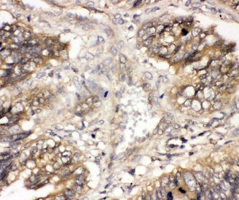 IHC staining of FFPE human intestinal cancer with CBL antibody. HIER: boil tissue sections in pH6, 1