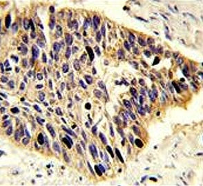 IHC testing of FFPE human lung carcinoma tissue with PA2G4 antibody. HIER: steam section in pH6 citr