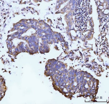 IHC staining of FFPE human gastric adenocarcinoma tissue with GLUL antibody. HIER: boil tissue secti