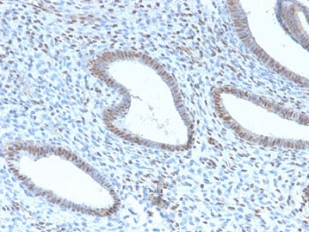 IHC testing of FFPE human endometrial carcinoma with recombinant TLE1 antibody (clone TLE1/2946R). R