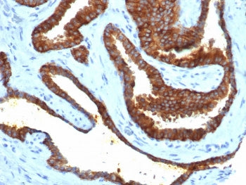 IHC staining of FFPE human prostate adenocarcinoma tissue with recombinant CD38 antibody (clone CD38