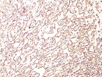 IHC: Formalin-fixed, paraffin-embedded human angiosarcoma stained with PODXL antibody (4F10).