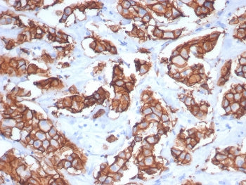 IHC staining of FFPE human breast carcinoma tissue with recombinant HER2 antibody (clone ERBB2/7158R