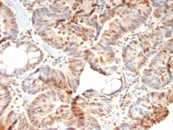 IHC staining of FFPE human colon carcinoma tissue with recombinant Retinoblastoma antibody (clone rR