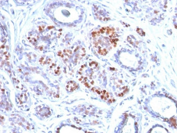 IHC testing of FFPE human breast carcinoma with GATA3 antibody. Required HIER: boil tissue sections 