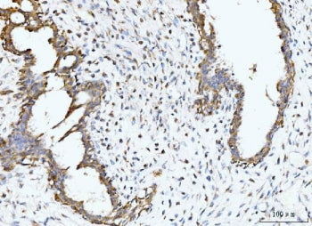 IHC staining of FFPE human breast cancer tissue with BCKDK antibody. HIER: boil tissue sections in p