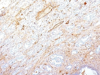 IHC: Formalin-fixed, paraffin-embedded human pancreatic adenocarcinoma stained with Fibronectin anti