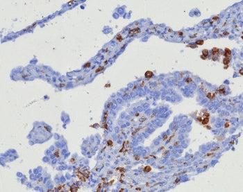 IHC staining of FFPE human ovarian carcinoma tissue with CD163 antibody (clone M130/8361R). HIER: bo
