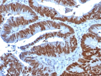 IHC testing of FFPE human colon carcinoma stained with p53 antibody (clone TP53/1739). Required HIER