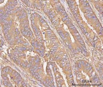 IHC staining of FFPE human rectum adenocarcinoma tissue with PPP3CB antibody. HIER: boil tissue sect