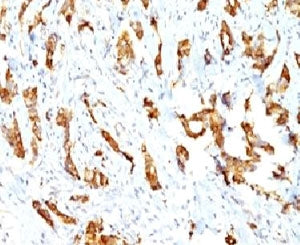 IHC: Formalin-fixed, paraffin-embedded human breast carcinoma stained with HSP27 antibody (clone SPM