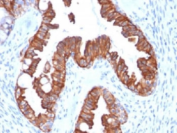 IHC testing of FFPE human endometrial carcinoma with recombinant Cytokeratin 7 antibody (clone rOV-T