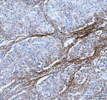 IHC staining of FFPE human lung cancer tissue with Lumican antibody. HIER: boil tissue sections in p