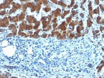 IHC: Formalin-fixed, paraffin-embedded human hepatocellular carcinoma stained with RBP (clone SPM442