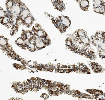 IHC staining of FFPE human renal cancer with ZFP42 antibody. HIER: boil tissue sections in pH8 EDTA 