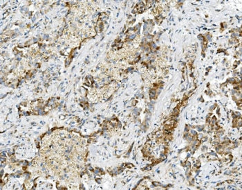 IHC staining of FFPE human lung cancer with USP16 antibody. HIER: boil tissue sections in pH8 EDTA f