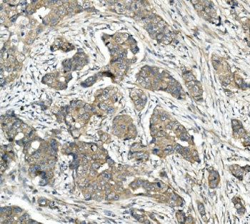 IHC staining of FFPE human breast cancer with CDR2 antibody. HIER: boil tissue sections in pH8 EDTA 