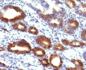 IHC testing of FFPE human gastric carcinoma with Mucin-6 antibody (clone MUCN6-1). FFPE testing requ