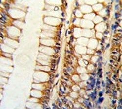 IHC testing of FFPE human colon carcinoma tissue with Bcl-2-like protein 11 antibody. HIER: steam se