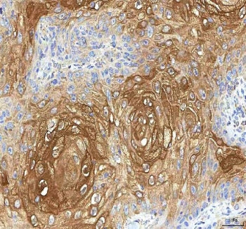 IHC staining of FFPE human skin cancer tissue with GOLGA7 antibody. HIER: boil tissue sections in pH