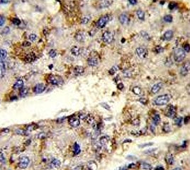 IHC testing of FFPE human hepatocellular carcinoma tissue with HNRPL antibody. HIER: steam section i