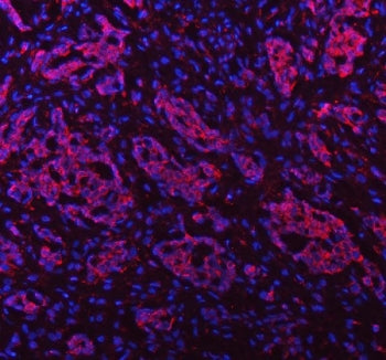 Immunofluorescent staining of FFPE human lung adenocarcinoma tissue with PAPSS2 antibody (red) and D