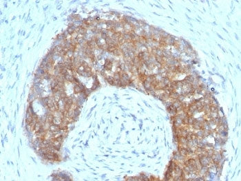 IHC: Formalin-fixed, paraffin-embedded human ovarian carcinoma stained with Estrogen Inducible Prote