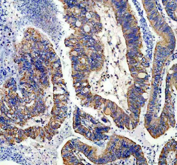 IHC staining of FFPE human colon cancer tissue with NDUFS1 antibody, HRP-secondary and DAB substrate
