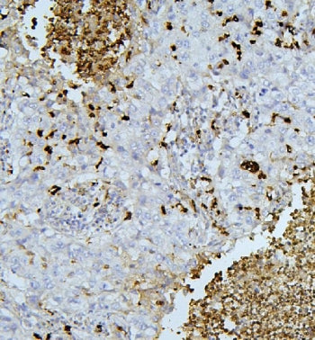 IHC staining of FFPE human lung cancer tissue with PEF1 antibody. HIER: boil tissue sections in pH8 