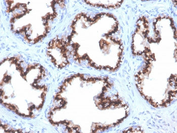 IHC staining of FFPE human prostate carcinoma with recombinant Prostein antibody (clone ZR9). HIER: 