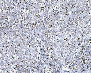 IHC staining of FFPE human lung cancer tissue with CD14 antibody. HIER: boil tissue sections in pH8 
