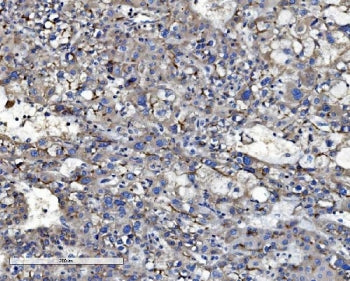 IHC staining of FFPE human liver cancer with ABCB1 antibody. HIER: boil tissue sections in pH8 EDTA 