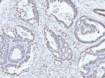 IHC staining of FFPE human rectal moderately differentiate adenocarcinoma tissue with MCM6 antibody.