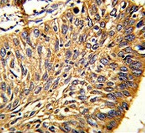 IHC testing of FFPE human lung carcinoma tissue with PRDX3 antibody. HIER: steam section in pH6 citr