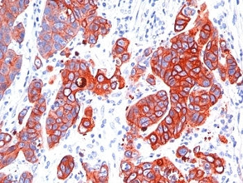 IHC: Formalin-fixed, paraffin-embedded human colon carcinoma stained with anti-Multi Cytokeratin ant