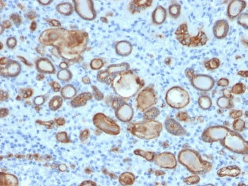 IHC staining of FFPE human thyroid carinoma with Occludin antibody (clone OCLN/2181). HIER: boil tis
