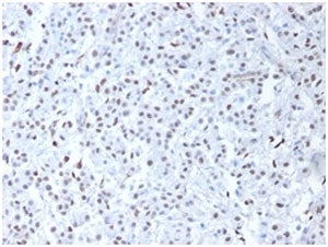 IHC staining of FFPE human mesothelioma with WT1 antibody. HIER: boil tissue sections in pH 9 10mM T
