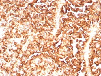 IHC staining of FFPE human melanoma tissue with recombinant S100A1 antibody (clone S100A1/9244R). HI