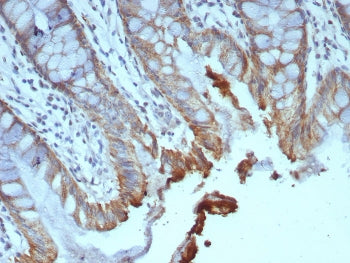 IHC staining of FFPE human colon carcinoma tissue with B7RP-1 antibody (clone ICOSL/7700). HIER: boi