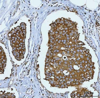 IHC staining of FFPE human breast cancer tissue with HSP90 alpha/beta antibody. HIER: boil tissue se