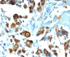 IHC testing of FFPE human gastric carcinoma with MUC3 antibody (clone MUCN3-1). Staining of formalin