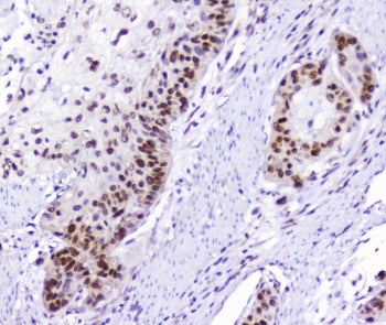IHC staining of FFPE human esophagus squamous cancer with AHR antibody at 1ug/ml. HIER: boil tissue 
