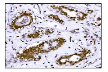 IHC staining of FFPE human breast cancer tissue with FTO antibody. HIER: boil tissue sections in pH8