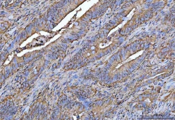 IHC staining of FFPE human colorectal adenocarcinoma tissue with PROSER3 antibody. HIER: boil tissue