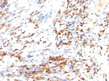 IHC: Formalin-fixed, paraffin-embedded human colon carcinoma stained with p27 antibody (DCS-72.F6 + 