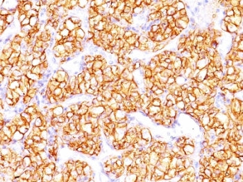 IHC: Formalin-fixed, paraffin-embedded human renal cell carcinoma stained with Carbonic Anhydrase 9 