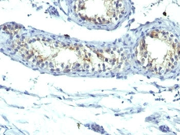 IHC: Formalin-fixed, paraffin-embedded human testicular carcinoma stained with Prolactin Receptor an