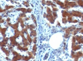 IHC testing of FFPE human hepatocellular carcinoma with RBP (clone RLBD1). Staining of formalin-fixe